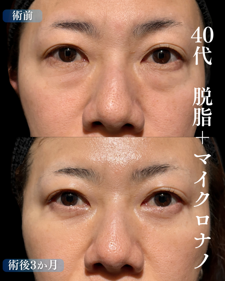 40代女性　脱脂+脂肪注入